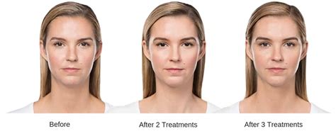 kybella reno|KYBELLA® in Reno, NV 